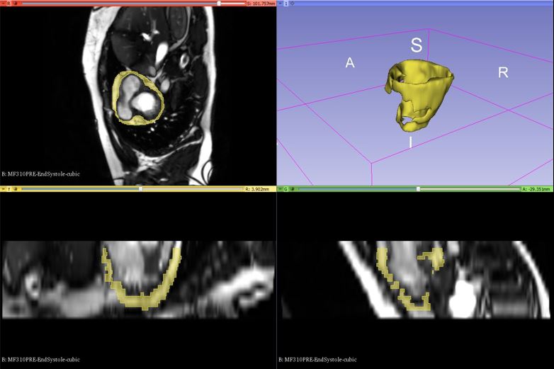 Cardiac MRI Fat
                    Segmentation